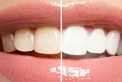 Blanqueamiento dental Gijón Asturias blanqueamiento dental gijon asturias