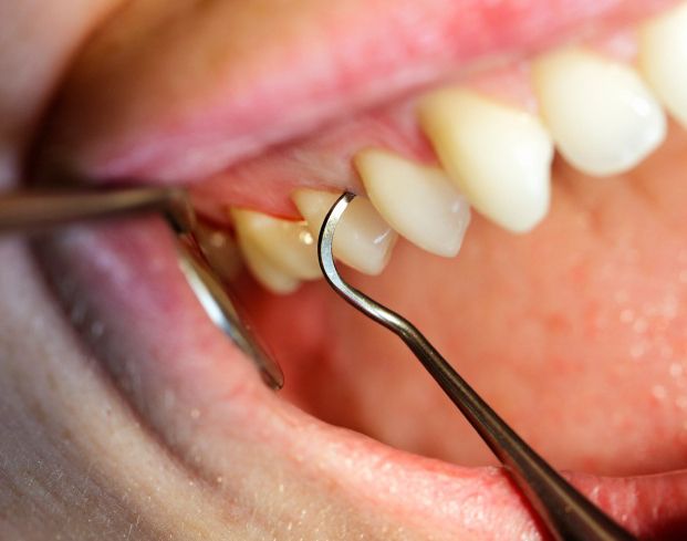 higiene dental Gijón higiene dental Gijón