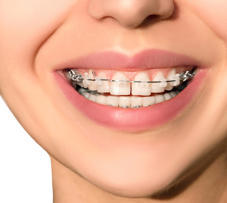 Cómo limpiar los dientes con ortodoncia Clínica Dental Dr. Arias